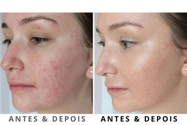 Resultados microagulhamento facial