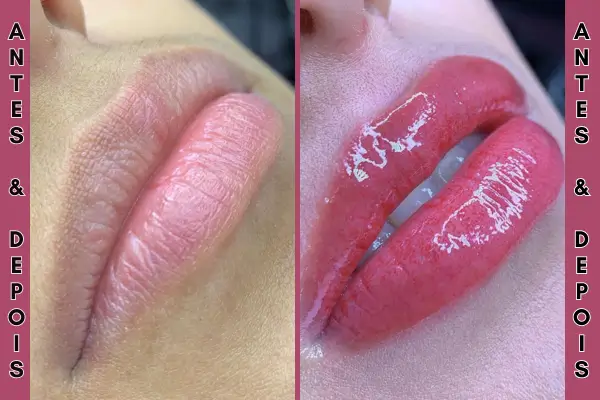 Resultado do tratamento Hydra Gloss Lips com lábios hidratados e brilhantes.