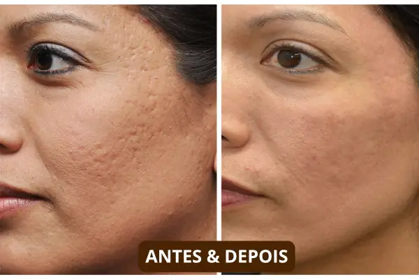 Resultados antes e depois microagulhamento facial