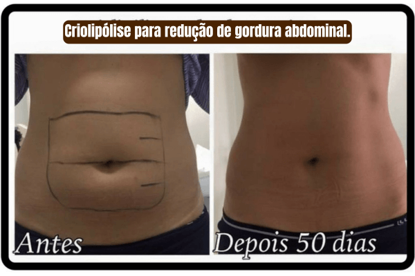 Antes e depois da criolipólise para redução de gordura abdominal.