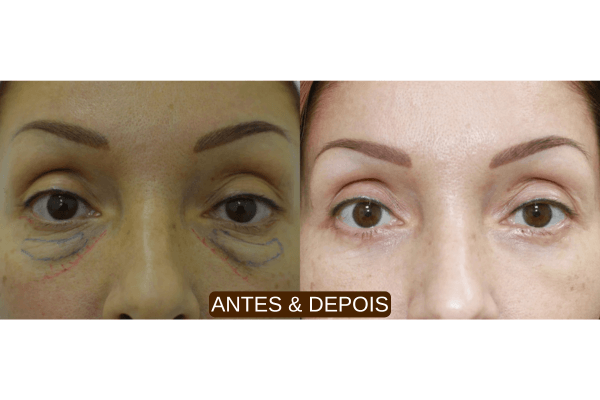 antes e depois jato de plasma