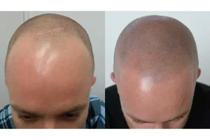 Micropigmentação capilar para disfarçar falhas no cabelo