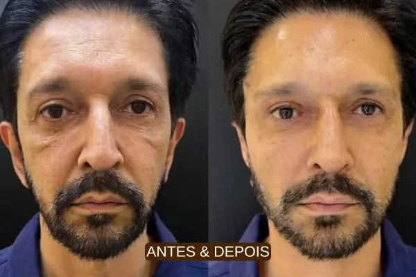 Antes e depois da harmonização facial do prefeito ricardo nunes com preenchimento de ácido hialurônico