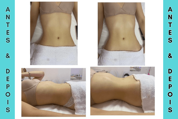 Resultados antes e depois massagem modeladora