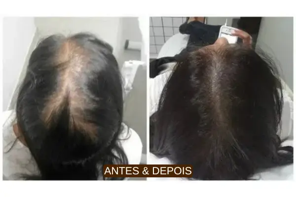 Resultados visíveis da terapia capilar - Antes e depois do tratamento